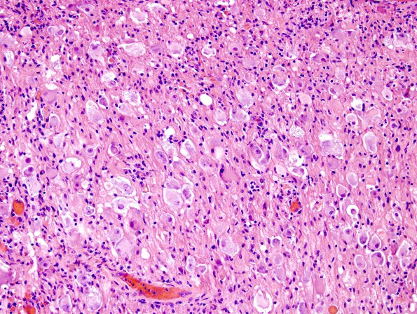 14A1 Ganglioglioma (Case 14) H&E 5