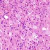 14A2 Ganglioglioma (Case 14) H&E 6