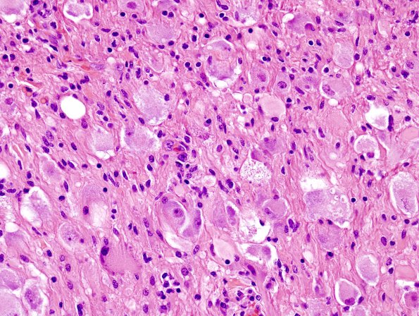 14A2 Ganglioglioma (Case 14) H&E 6