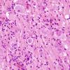 14A3 Ganglioglioma (Case 14) H&E 9