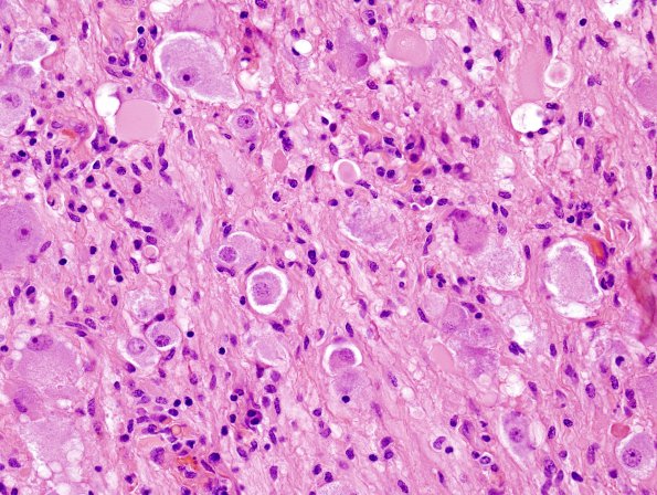 14A3 Ganglioglioma (Case 14) H&E 9