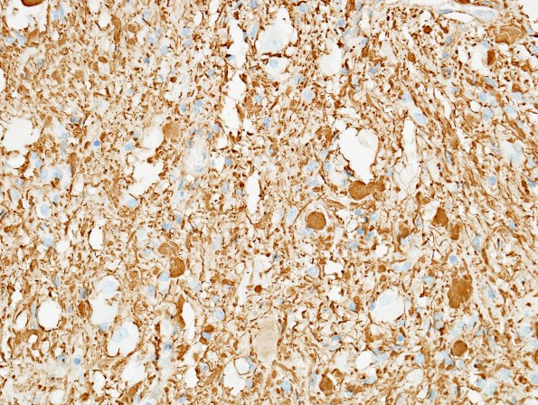 14B1 Ganglioglioma (Case 14) NF 1