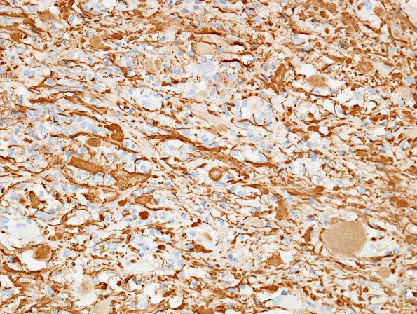 14B2 Ganglioglioma (Case 14) NF 4