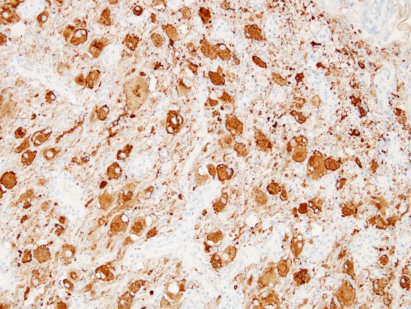 14C Ganglioglioma (Case 14) Chromogranin 2