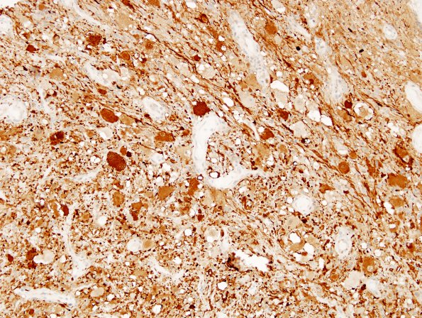 14D1 Ganglioglioma (Case 14) Calretinin 2