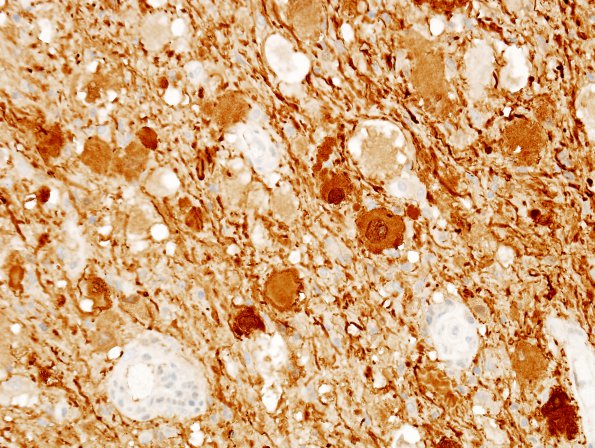 14D2 Ganglioglioma (Case 14) Calretinin 1