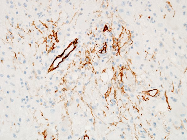 14E Ganglioglioma (Case 14) CD34 1