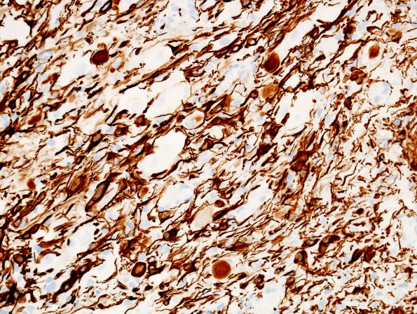 14F Ganglioglioma (Case 14) GFAP 5