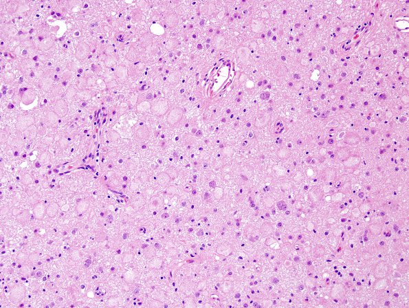 15A1 Ganglioglioma (Case 15) H&E 3