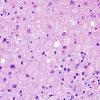 15A2 Ganglioglioma (Case 15) H&E 4