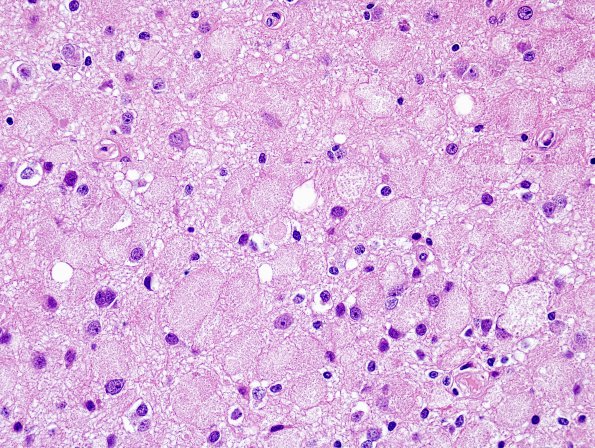 15A2 Ganglioglioma (Case 15) H&E 4