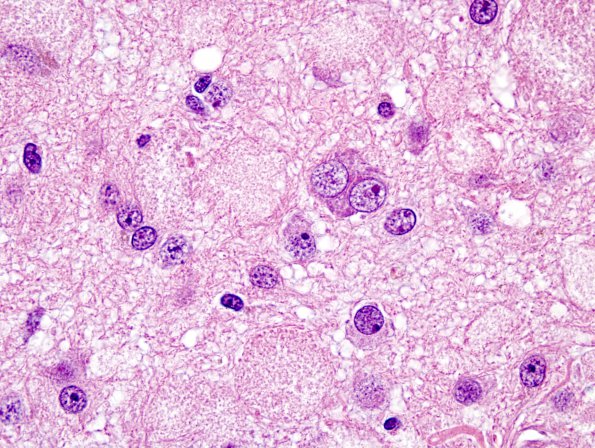 15A3 Ganglioglioma (Case 15) H&E 6