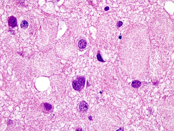 15A4 Ganglioglioma (Case 15) H&E 8