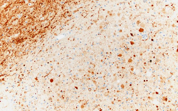 15B1 Ganglioglioma (Case 15) SYN 20X