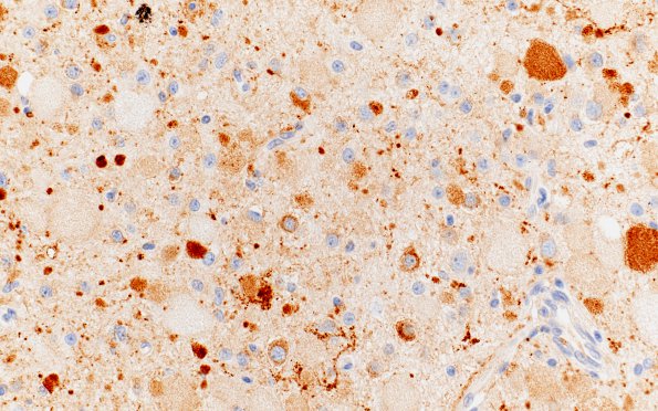 15B2 Ganglioglioma (Case 15) SYN 40X