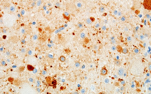 15B3 Ganglioglioma (Case 15) SYN 60X