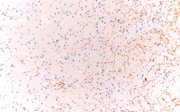 15C1 Ganglioglioma (Case 15) NF 20X