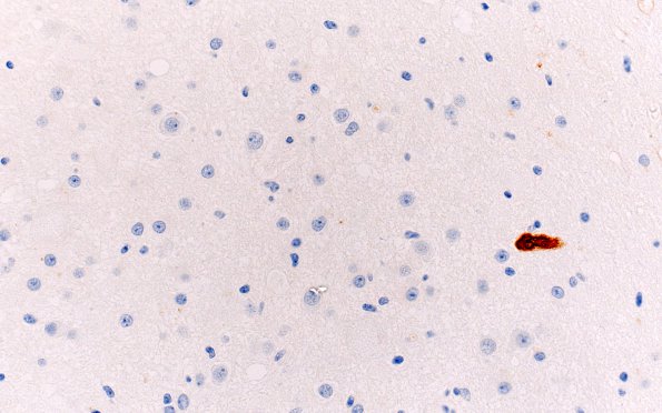 15D2 Ganglioglioma (Case 15) NeuN 40X