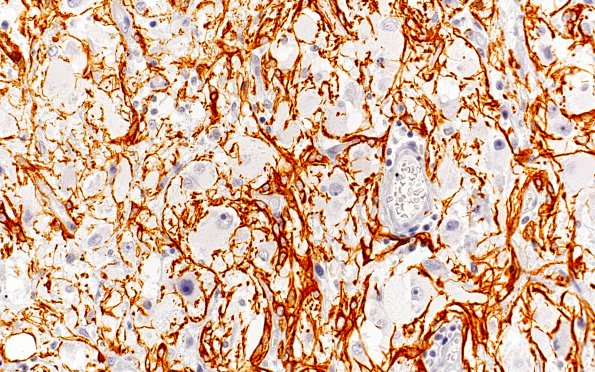 15E2 Ganglioglioma (Case 15) GFAP 40X 2