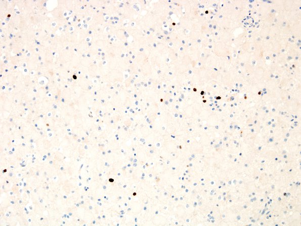 15G Ganglioglioma (Case 15) MIB