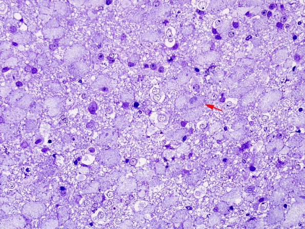 15H Ganglioglioma (Case 15) Plastic 2 copy