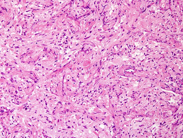 16A2 Ganglioglioma (Case 16) H&E 4.jpg