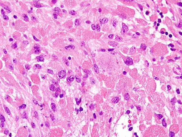 16A4 Ganglioglioma (Case 16) H&E 10.jpg