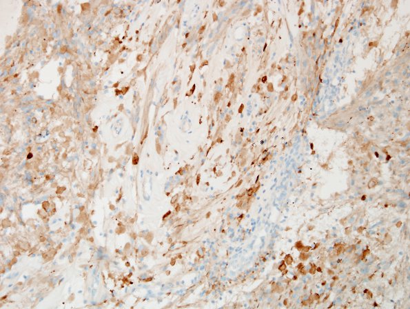 16B2 Ganglioglioma (Case 16) SYN 5.jpg