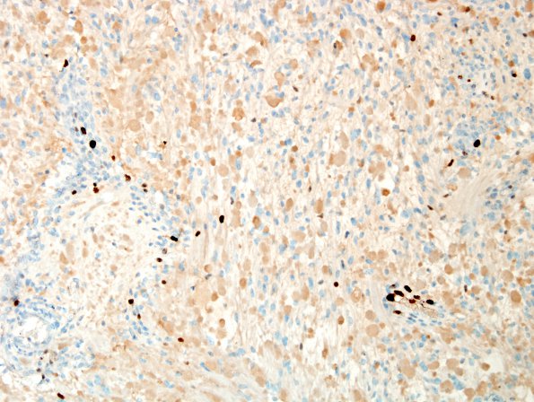 16D Ganglioglioma (Case 16) Ki67 3.jpg