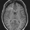 17A1 Ganglioglioma (Case 17) T1 (intraoperative) copy - Copy