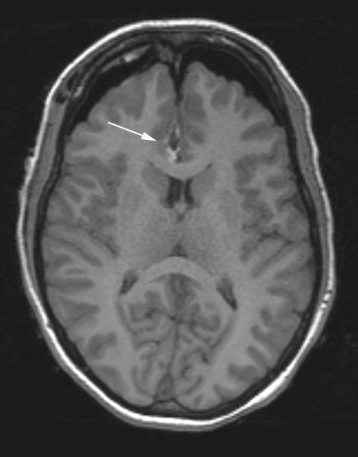 17A1 Ganglioglioma (Case 17) T1 (intraoperative) copy - Copy