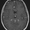 17A2 Ganglioglioma (Case 17) T1 W 1 - Copy