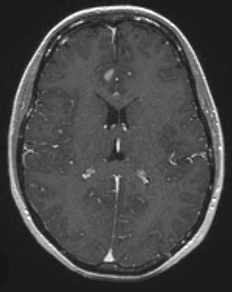 17A2 Ganglioglioma (Case 17) T1 W 1 - Copy