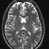 17A3 Ganglioglioma (Case 17) T2 W 1 - Copy