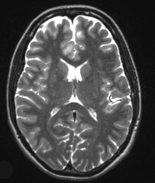 17A3 Ganglioglioma (Case 17) T2 W 1 - Copy