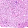 17B1 Ganglioglioma (Case 17) H&E 14.jpg