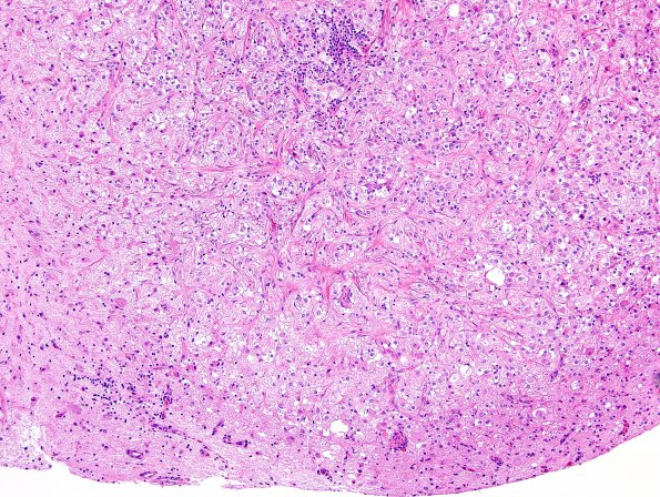 17B1 Ganglioglioma (Case 17) H&E 14.jpg