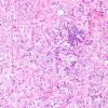 17B2 Ganglioglioma (Case 17) H&E 15.jpg