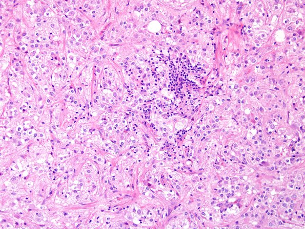 17B2 Ganglioglioma (Case 17) H&E 15.jpg