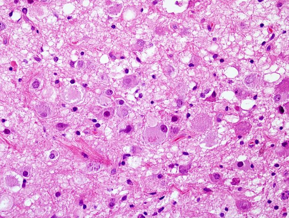 17B3 Ganglioglioma (Case 17) H&E 10.jpg