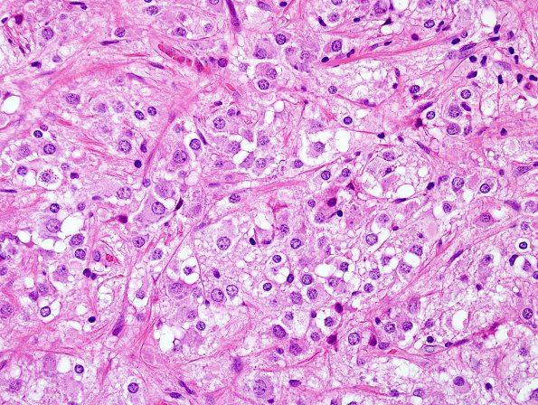 17B4 Ganglioglioma (Case 17) H&E 2.jpg