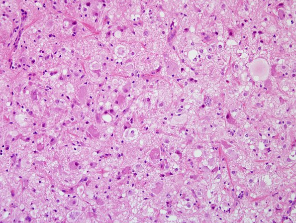 17B5 Ganglioglioma (Case 17) H&E 12.jpg