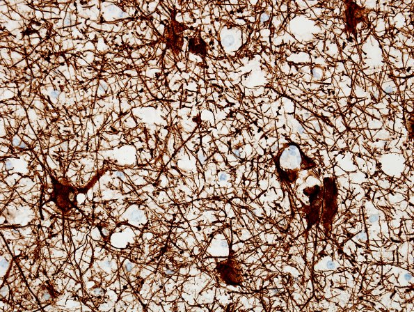 17C Ganglioglioma (Case 17) GFAP.jpg