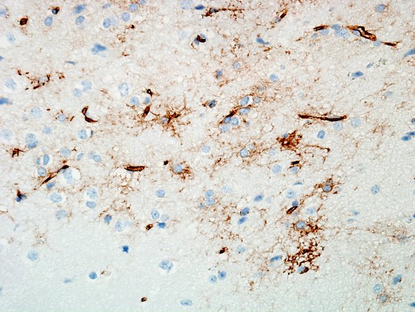 17D Ganglioglioma (Case 17) CD34 3.jpg