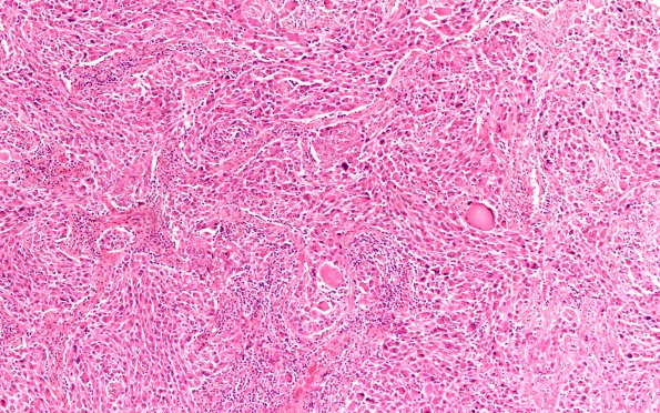 18A1 Ganglioglioma (Case 18) H&E 10X