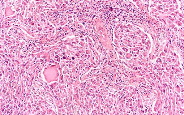 18A2 Ganglioglioma (Case 18) H&E 20X