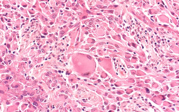 18A3 Ganglioglioma (Case 18) H&E 40X