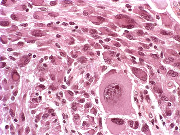 18A5 Ganglioglioma (Case 18) H&E 1
