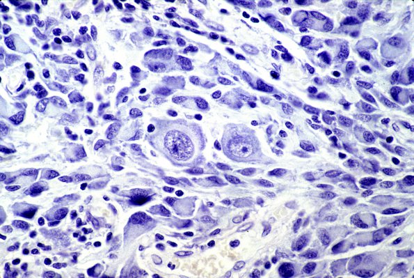 18B Ganglioglioma (Case 18) Nissl