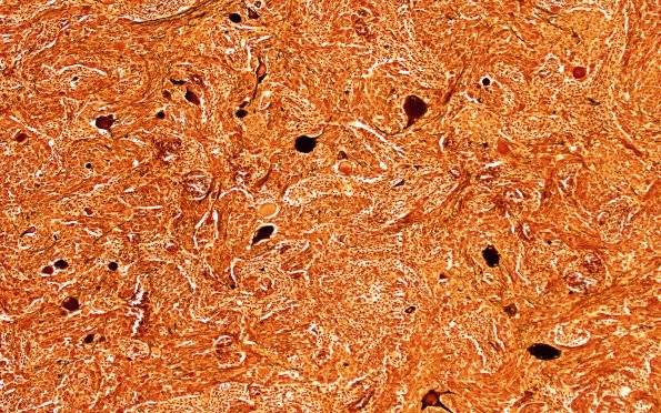 18C1 Ganglioglioma (Case 18) Biels 10X